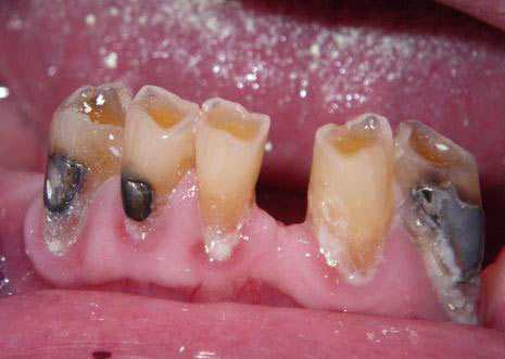 lower, plaque covered teeth